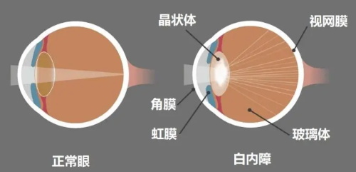 白内障手术示意图