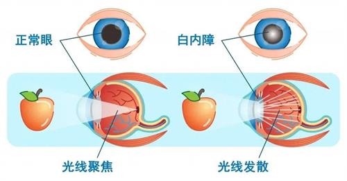 白内障手术治疗示意图
