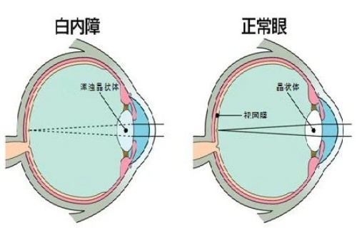 白内障手术大概需要多少钱?一键了解白内障手术晶体价格