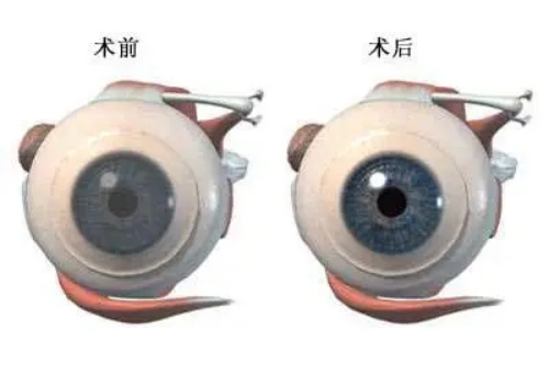 角膜移植术前术后示意图