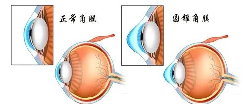 圆锥角膜和正常的示意图
