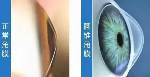 圆锥角膜示意图