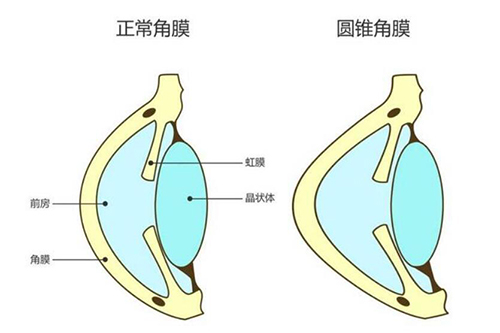圆锥角膜手术多少钱?三种靠谱术式收费情况分享!