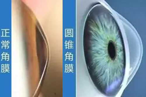 正常角膜对比圆锥角膜图展示