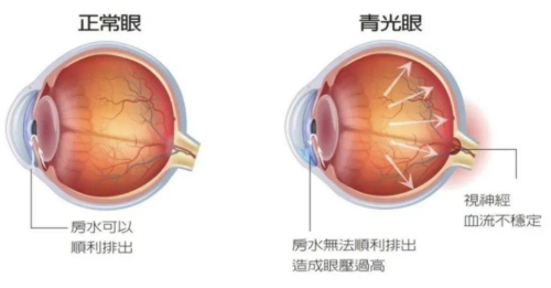 青光眼与正常眼睛区别