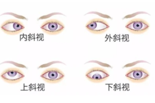 斜视种类卡通图