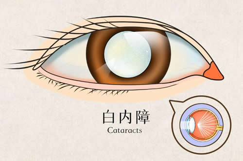 白内障不治疗会瞎吗,白内障手术大概多少钱?