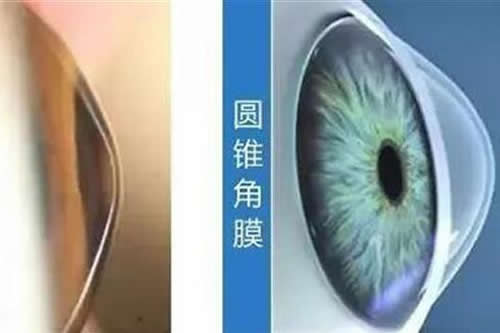 不同特点角膜展示