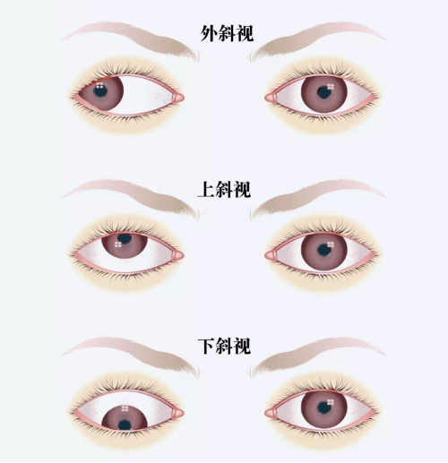 斜视不同情况示意图