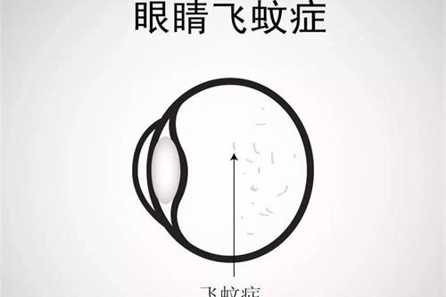 飞蚊症眼睛示意图