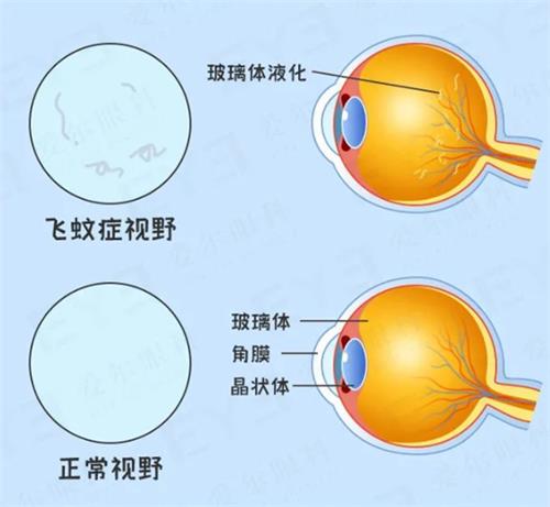 飞蚊症和正常眼视野示意图