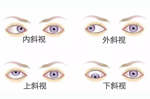 斜视眼怎么造成的?原因+靠谱的矫正方法一一公布!