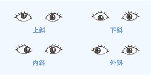 斜视的分类
