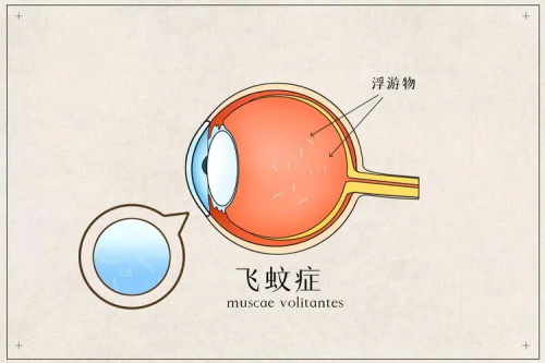 飞蚊症的示意图