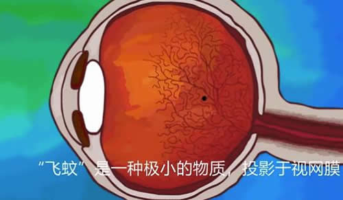飞蚊症卡通宣传图