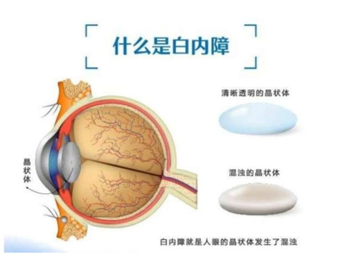 白内障概念示意图