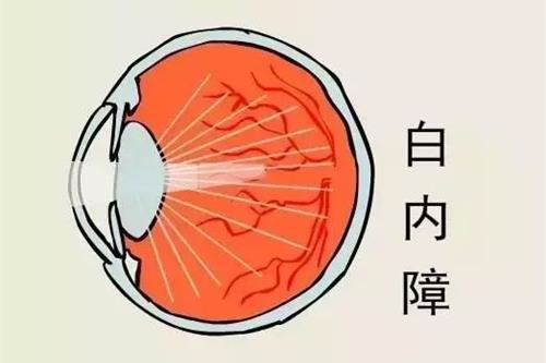 老人白内障手术较佳时期,80岁有没有必要做白内障手术