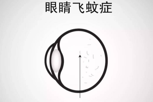 飞蚊症怎么办