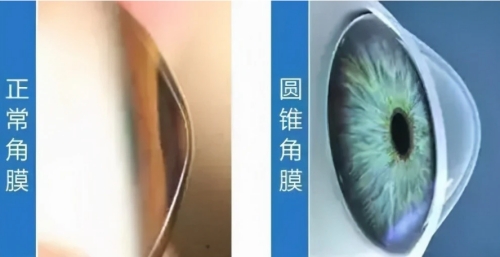 正常角膜与圆锥角膜对比图