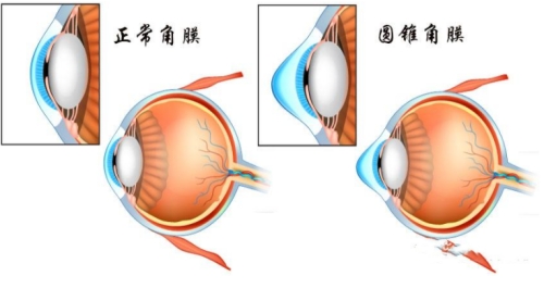圆锥角膜如何治疗