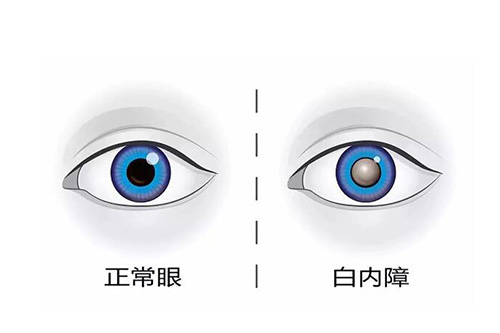 白内障手术大概需要多少钱?详细价格+注意事项分享!