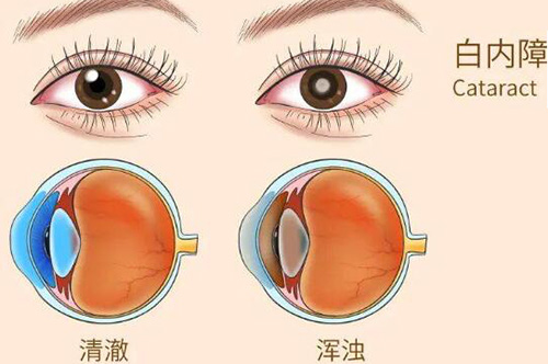 白内障照片展示图