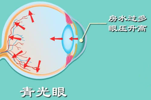 青光眼的症状有哪些,青光眼治疗收费一般是多少?