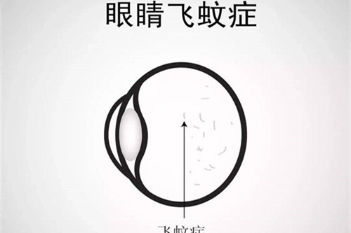 飞蚊症展示图
