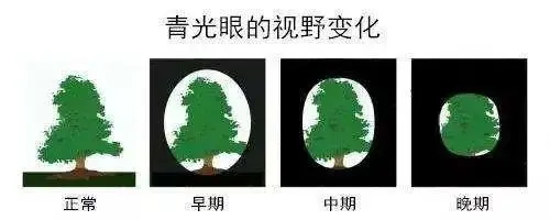青光眼视野变化示意图