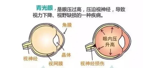 青光眼的形成原因