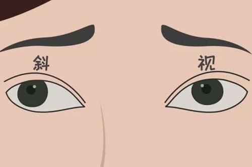 眼睛斜视矫正手术多少钱,成年人眼睛斜视能治吗?