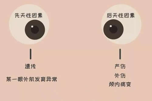 眼睛斜视原因科普