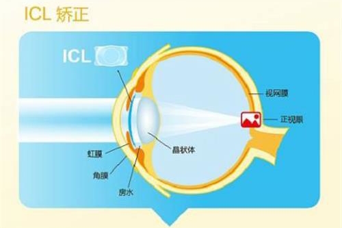 近视手术价格一览表,2024近视矫正大概多少钱看这篇就行