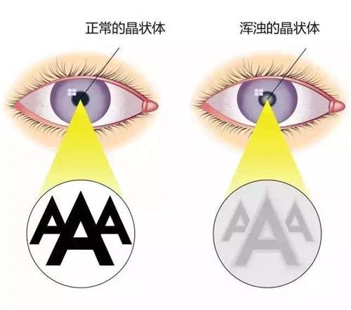 白内障视力和正常视力的对比