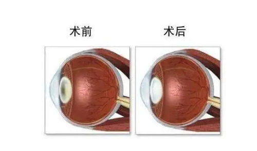 白内障手术后的成效