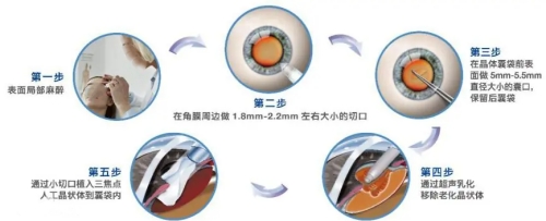 三焦点人工晶体手术步骤图