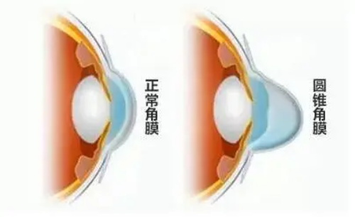 正常角膜和不正常角膜的对比