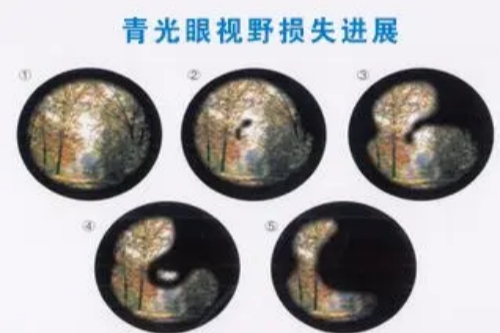 青光眼早期的症状是什么?青光眼和眼疲劳怎么区分?