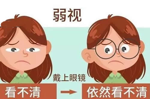 眼睛弱视卡通图