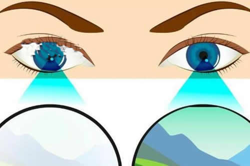 眼睛弱视和正常眼睛对比