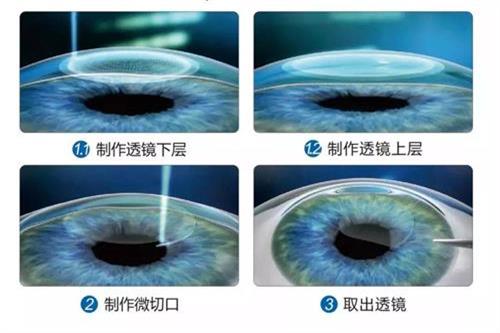 【飞秒手术问题合集】分析利与弊及术后的危害,注意事项