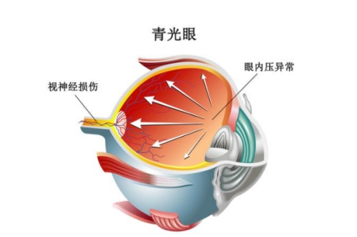 青光眼的症状有哪些