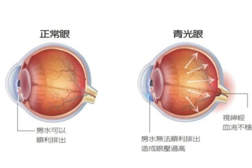 正常眼睛与青光眼的区别