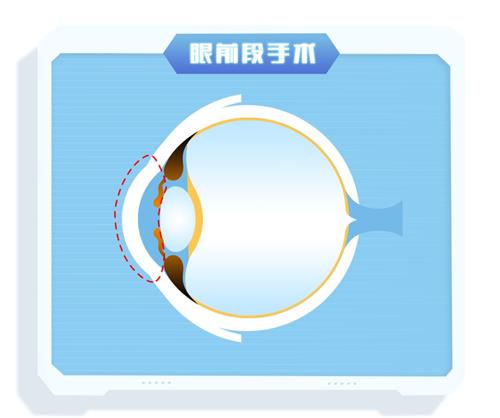 近视手术的部位