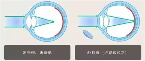 眼睛佩戴角膜塑形镜和不佩戴的区别