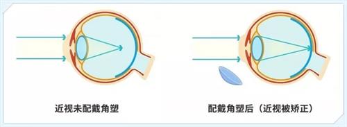 近视佩戴角膜塑形镜后的成效