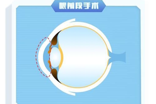 一起了解千频优视近视手术?和全飞秒哪个好?价格多少钱