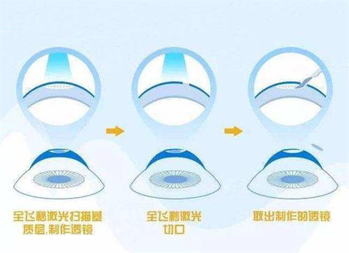 飞秒近视眼手术过程