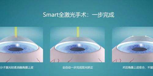 飞秒近视眼手术步骤示意图