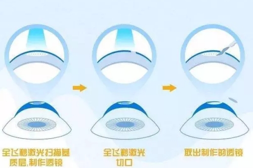 全飞秒手术步骤图